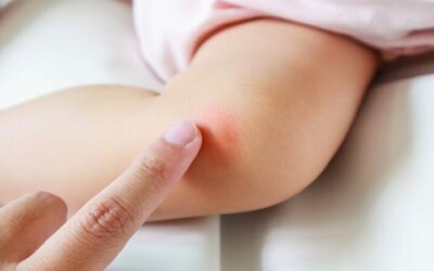 علاج الطفح الجلدي المفاجئ عند الاطفال