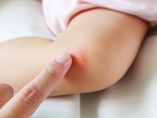 علاج الطفح الجلدي المفاجئ عند الاطفال